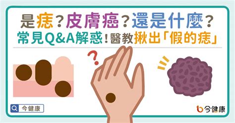 痣突出來|是痣？皮膚癌？還是什麼？常見Q&A解惑！醫教揪出「。